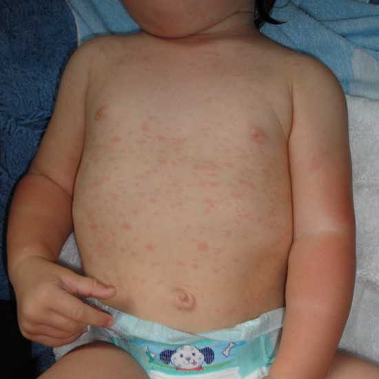 Roseola On Babies